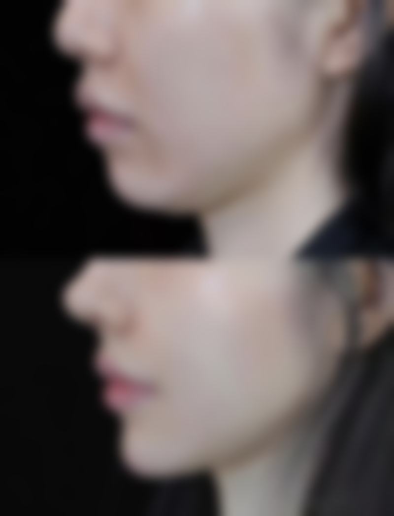 自体隆鼻软骨后遗症大揭秘：感染风险及预防