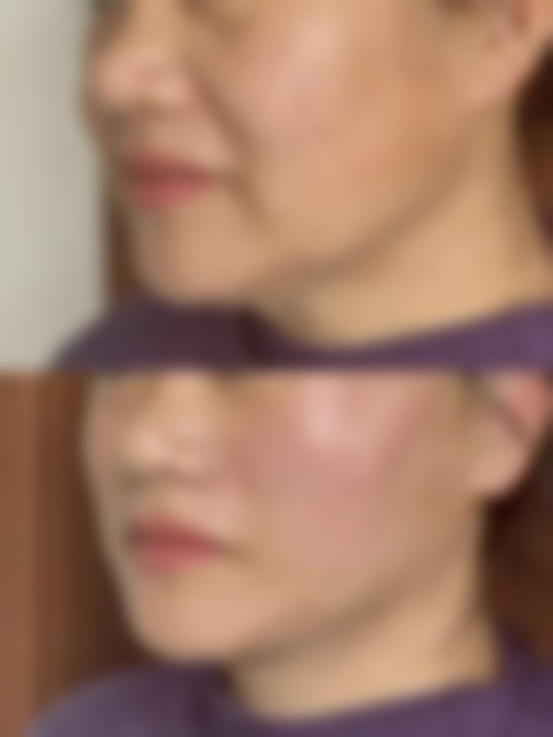 自体隆鼻软骨后遗症大揭秘：应对措施与修复注意事项