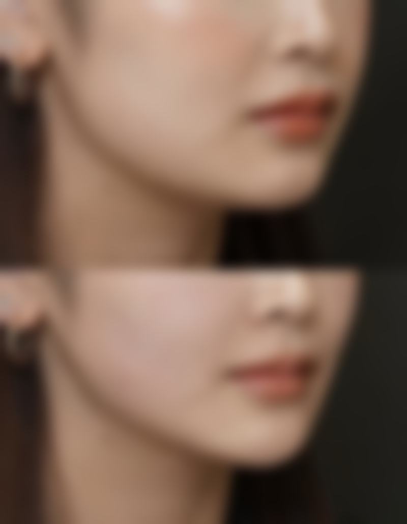 氨基糖苷类抗生素，瘦脸针后要远离