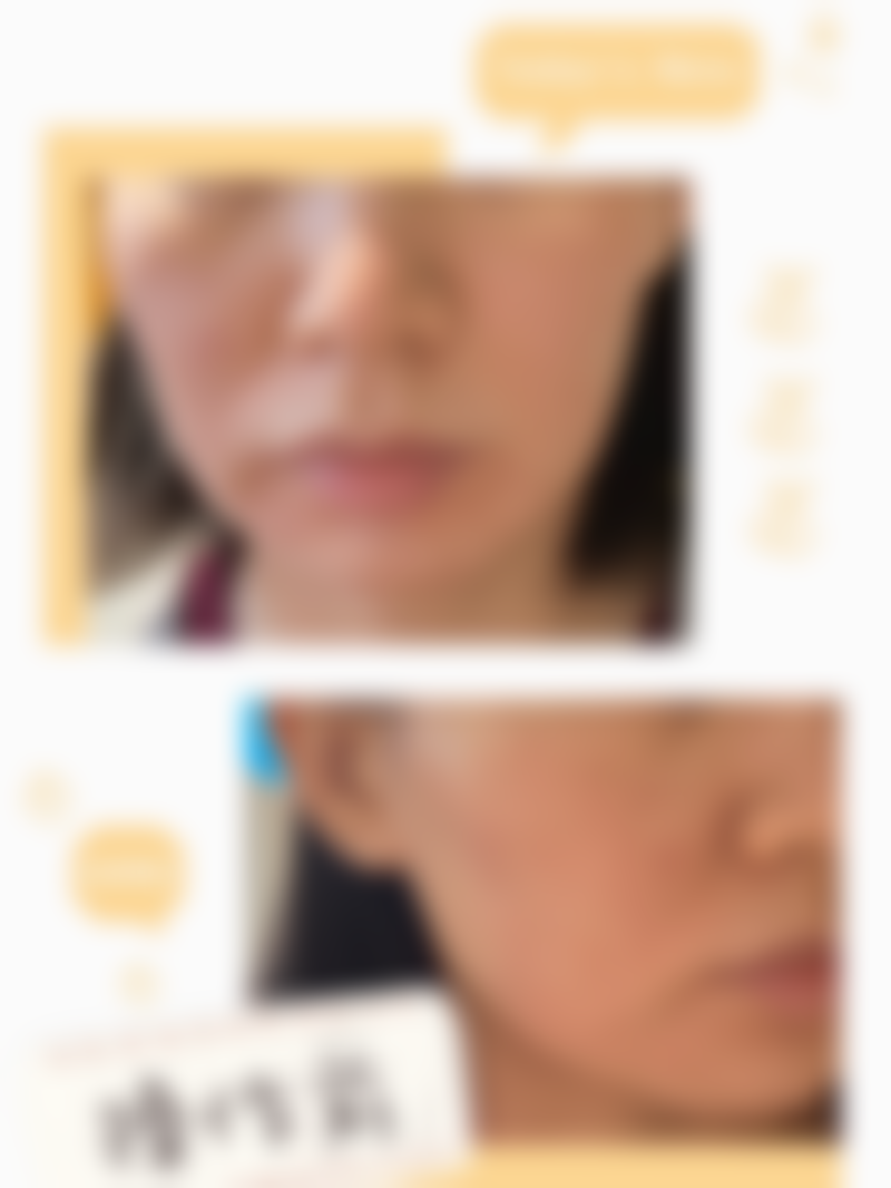 30岁抗初老！我在广东韩妃做半岛超声炮，40分钟紧致中下面部效果超绝 