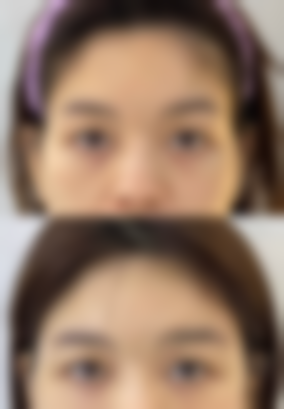 活血中成药也危险，瘦脸针后要警惕