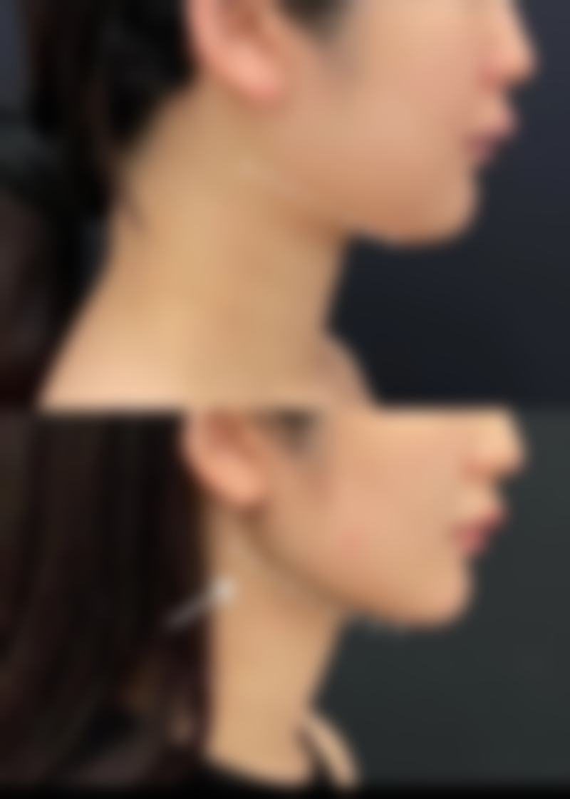 快速除眼袋小窍门大揭秘！日常护理与医美方案结合，让你告别熊猫眼