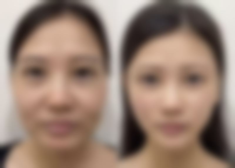 快速除眼袋小窍门大揭秘！术后护理不可忽视