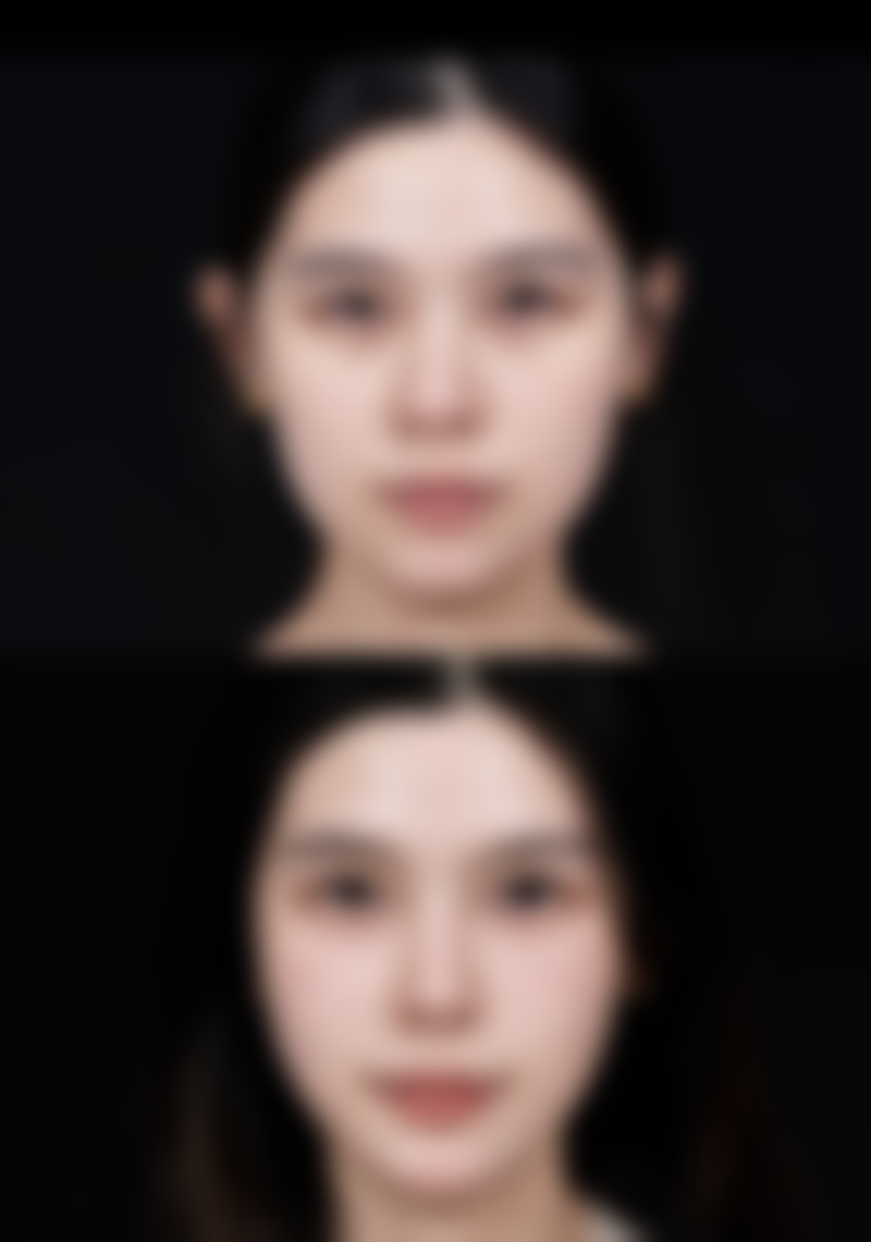 怎样选优质膨体隆鼻？射极峰膨体的独特优势与适用场景