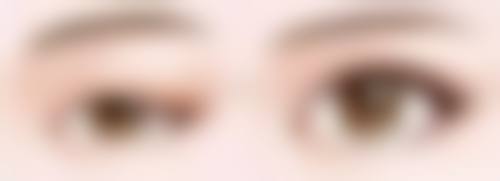 做双眼皮1 - 3个月：消肿持续形态初定