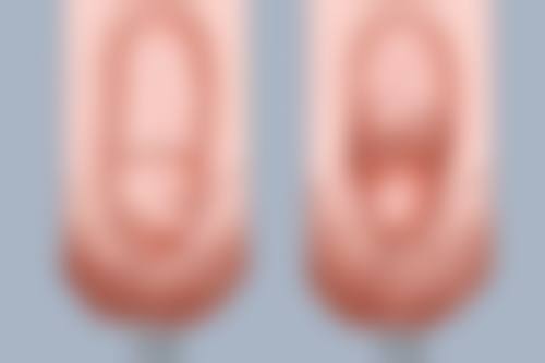 马严切包皮实例