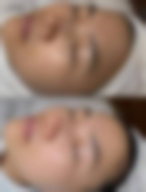 曹志明激光祛斑水平怎么样可靠吗？