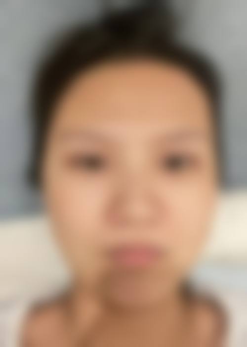 黎咏璇头面部整形实例