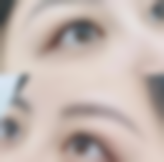 瘢痕体质做埋线双眼皮？了解手术细节与风险预警，为美丽安全护航 