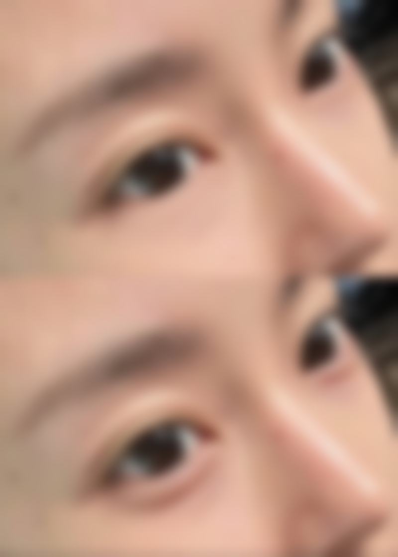 做双眼皮各阶段护理要点总结