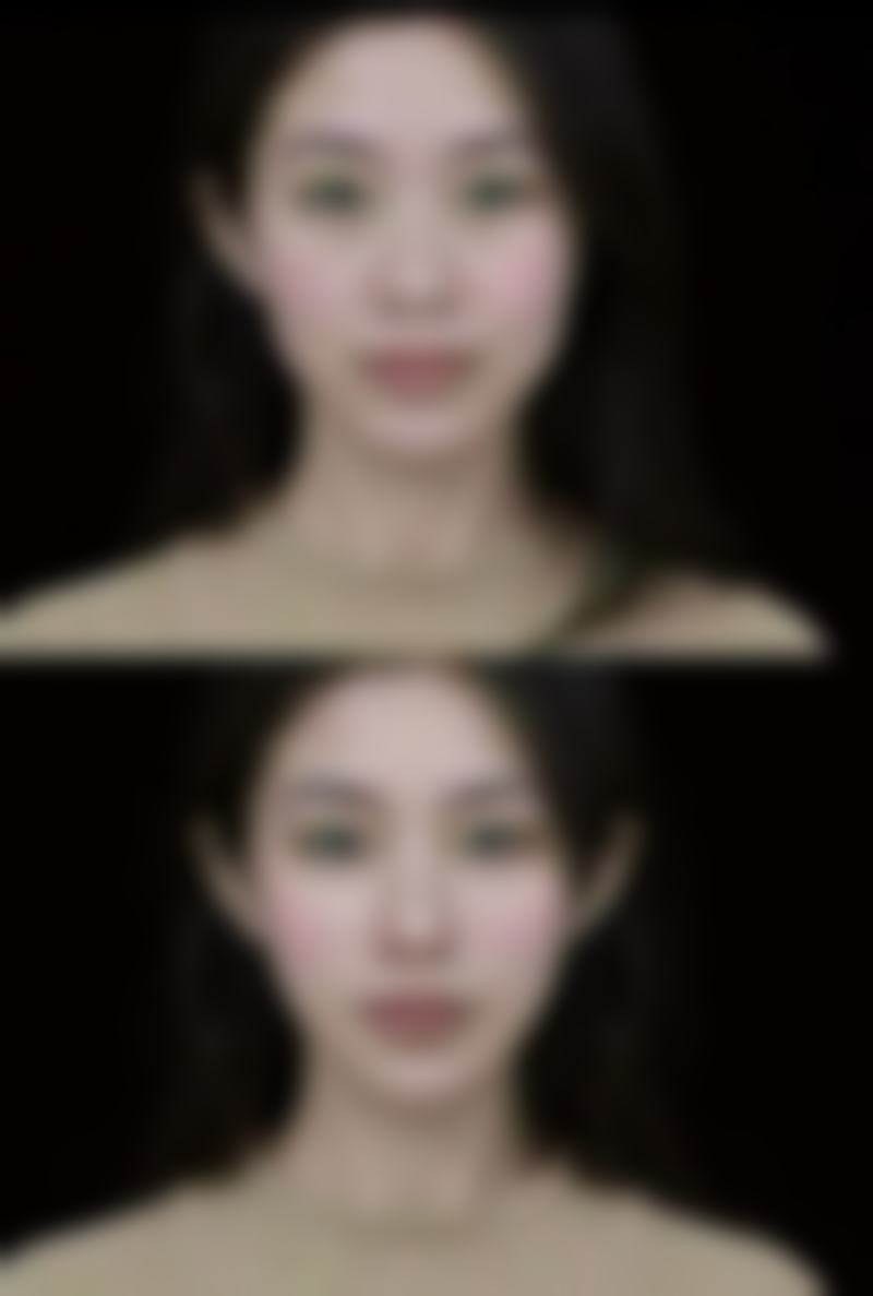 做双眼皮手术前要准备什么？了解身体、心理及细节准备，选正规医院开启变美之旅 