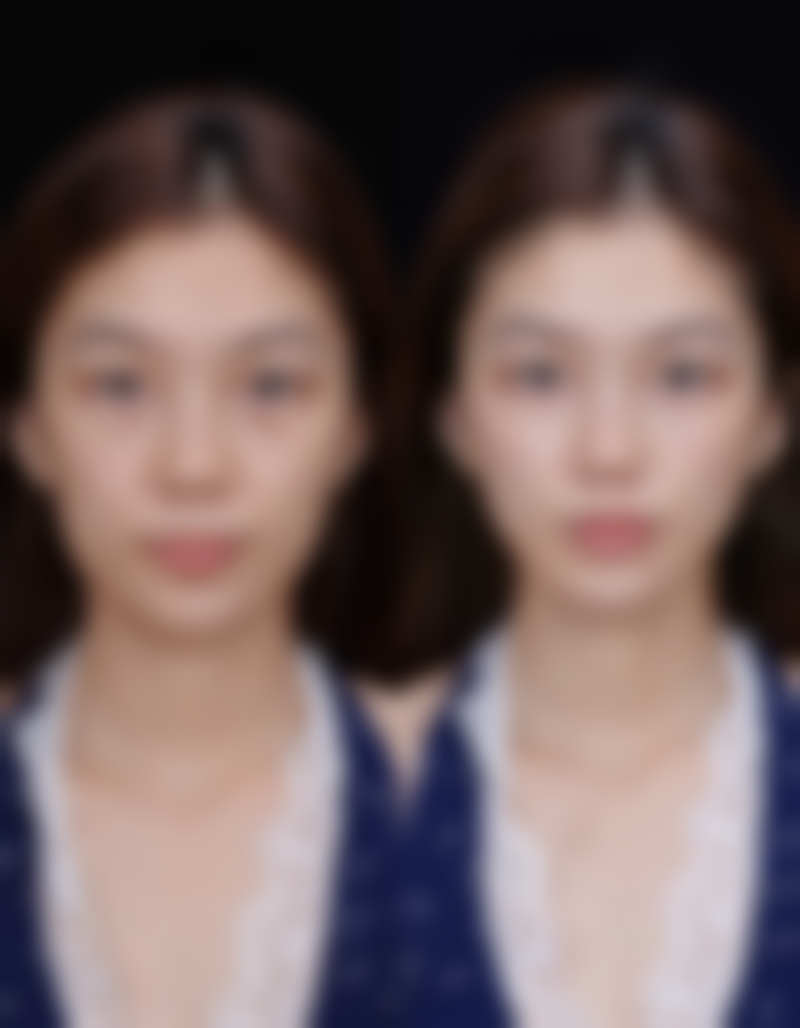 增生疤痕治疗之注意事项：术后护理特别重要