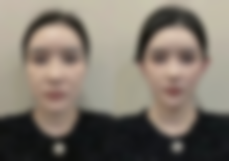 四、广州轻雅玥美整形医院实例