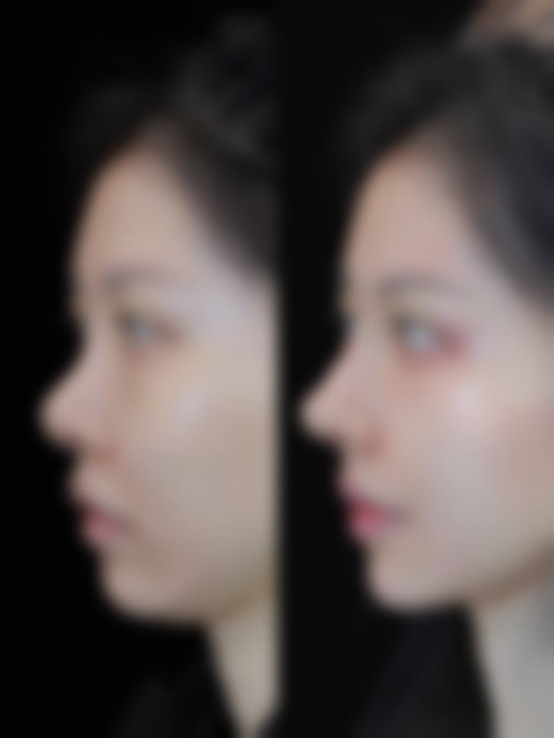 双眼皮埋线风险可控吗？专业医院助力，低风险打造自然灵动双眼皮 