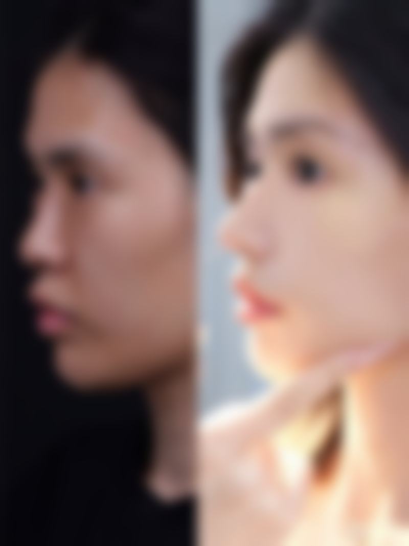 哪些人适合埋线双眼皮，哪些人不适合？