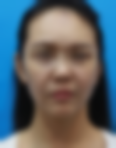 我在北京加减美做19800面部提拉术后 苹果肌紧致嘴角不垂鼻唇沟淡还爱自拍