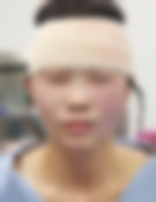 手术过程和修复初期的真实体验