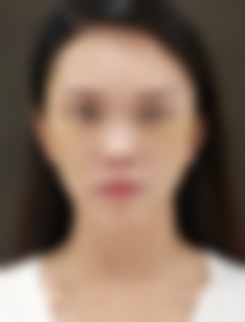 现在的状态：每天自拍停不下来！苹果肌、嘴角、鼻唇沟的变化太绝