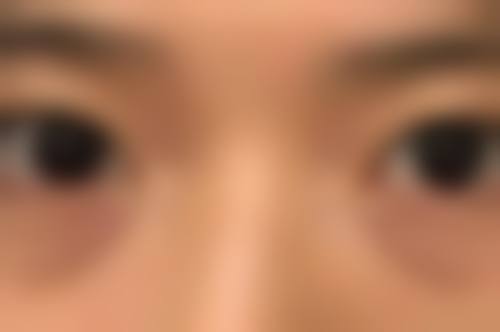 下眼袋一直抽搐别慌！专精医院来助力