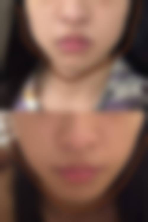 郑允皓微整注射实例