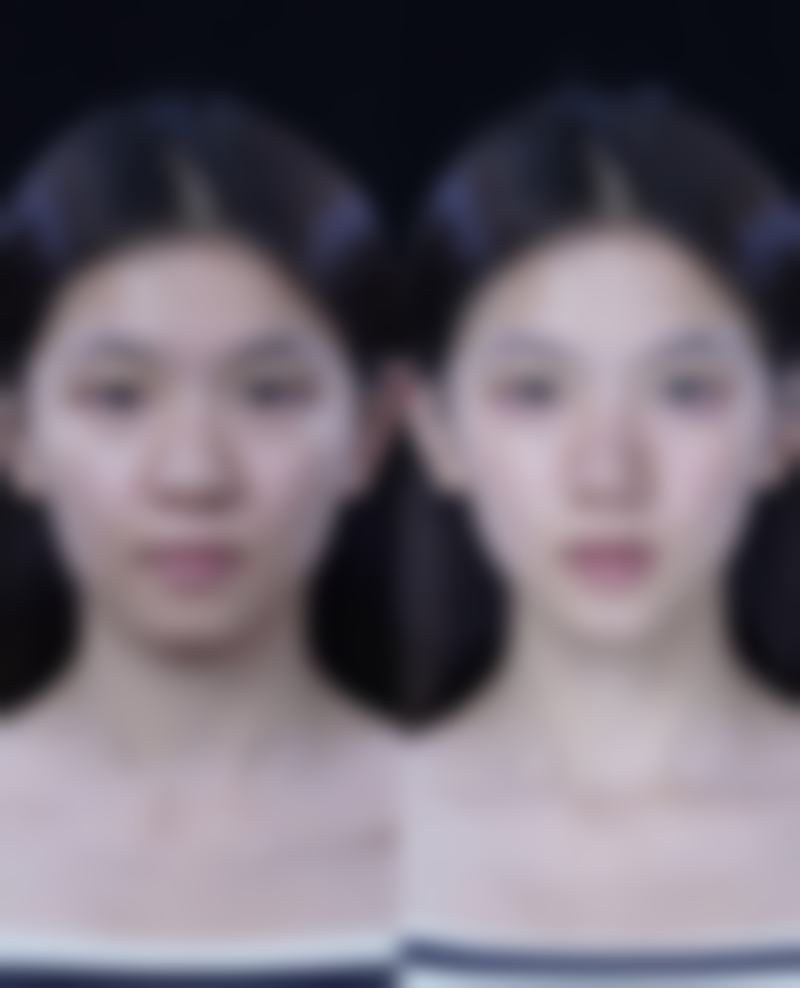 多因素影响下，哪些因素决定抽脂风险高低