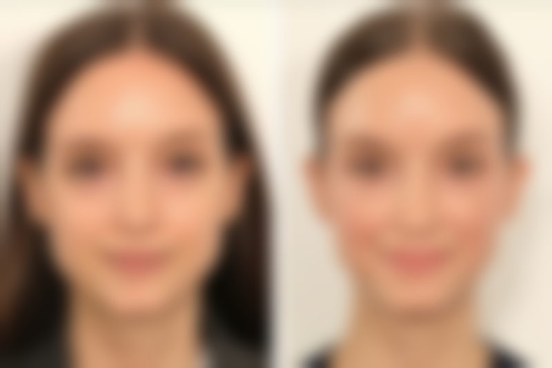 疤痕疙瘩抹什么药更好？常见药物特点对比