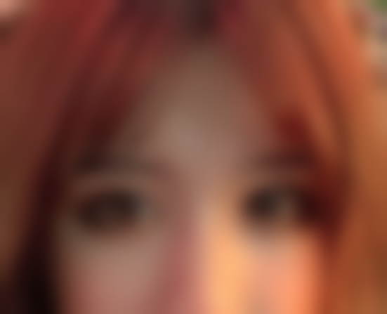 我在松山医院找兰宇做眼综合 术后一个月单双眼终于对称变好看花12800啦