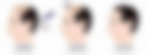 促进修复，让翻白眼早日实现