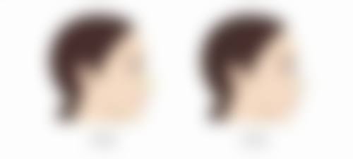 不同术式后遗症风险有啥不同？了解清楚更好选