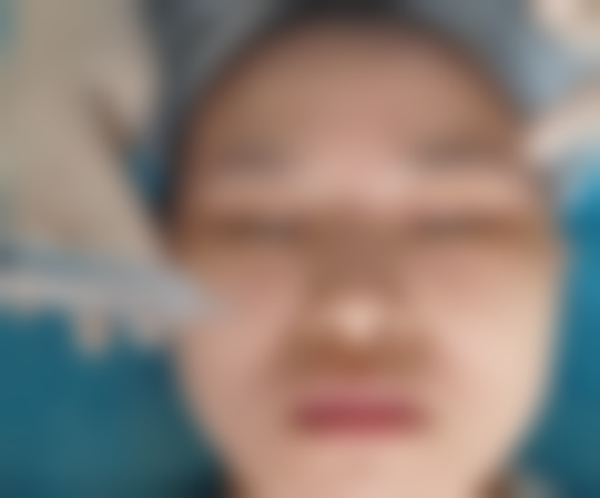 五次疗程亲测成效：混油敏皮终于变水润！