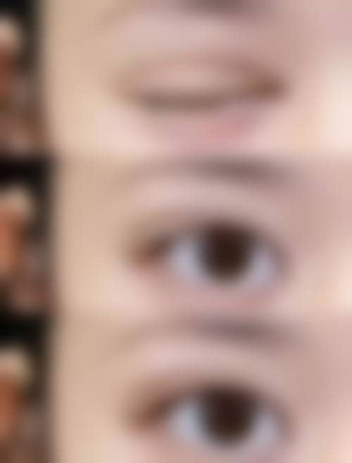 蔡里眼部整形实例