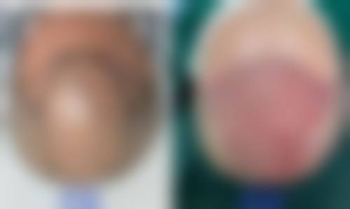 金昌植鲜红斑痣治疗水平怎么样可靠吗？