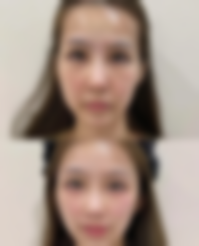 轻松搞定下眼袋！选择靠谱的医美医院