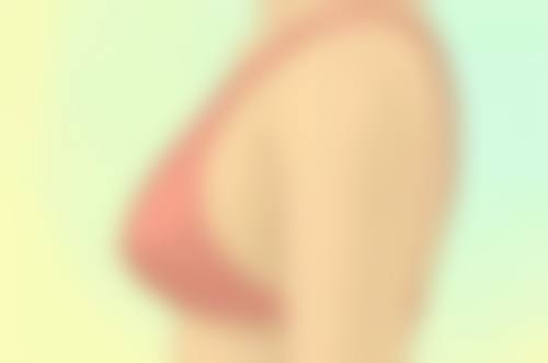 隆胸后取出假体胸部会变形吗？是否需要修复干预