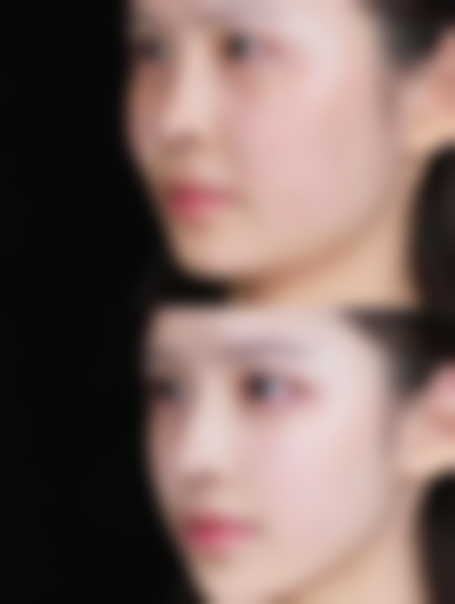 怎样快速去除眼袋淤青？医美手段：效率高的专精选择