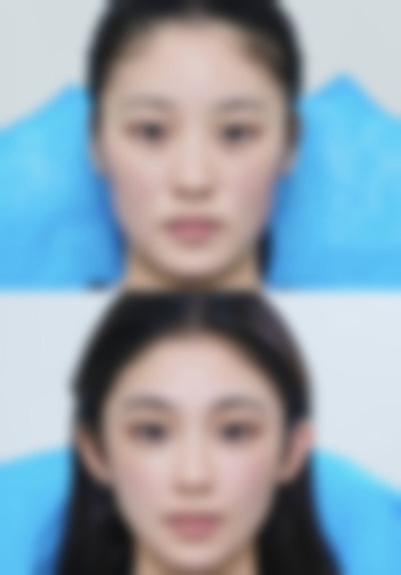 怎样快速去除眼袋淤青？冷热敷、药物辅助与医美手段结合，加速消退恢复光彩 