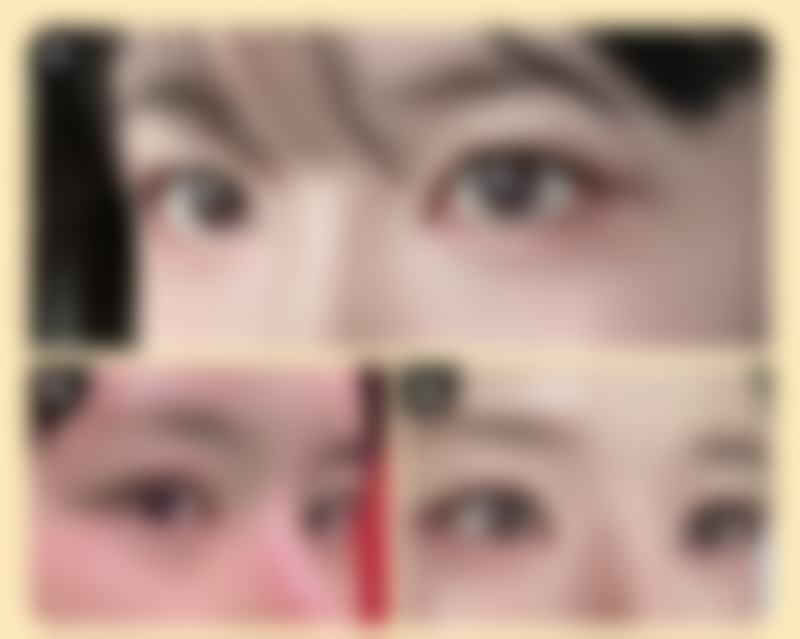 四、长沙如美整形医院实例