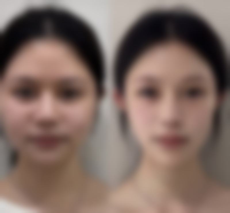 不同程度凹陷疤痕的综合治疗方案