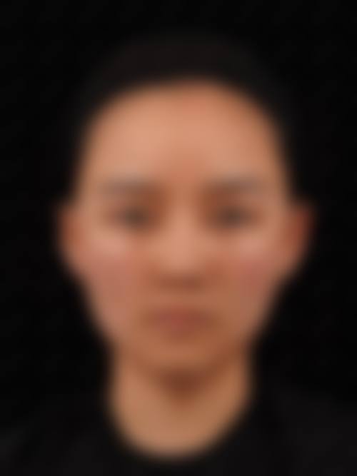 魏军剑医生CH活细胞自体脂肪填充术实例