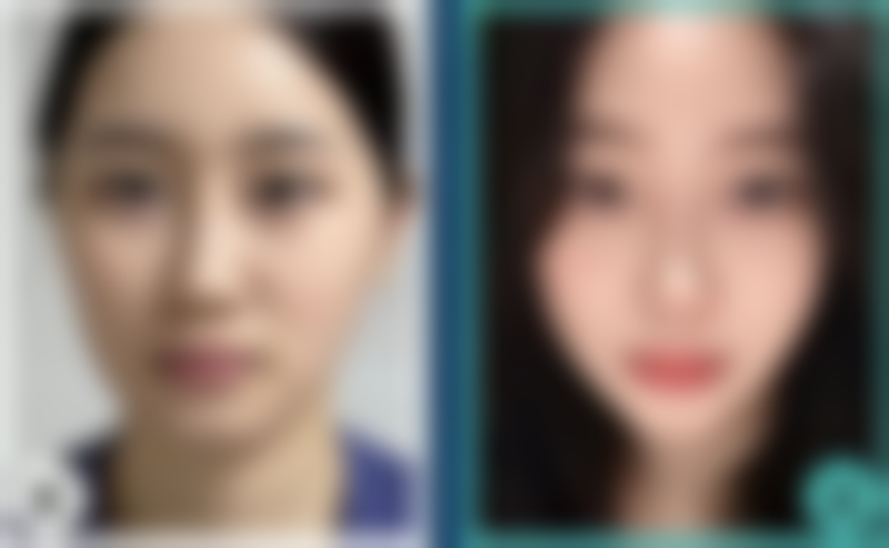 五、南京丝屿臻珠整形医院实例