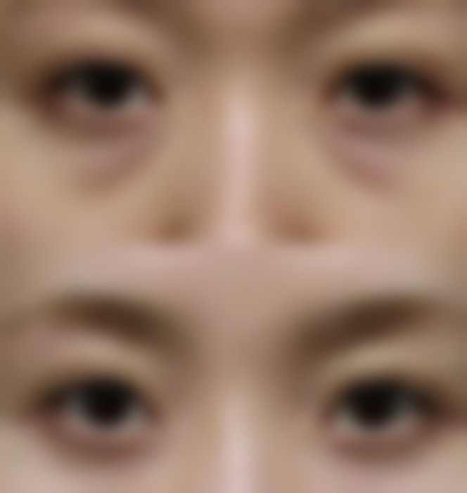 腿部吸脂该选多少个部位？个性化方案多部位抽吸，保障效果与安全 