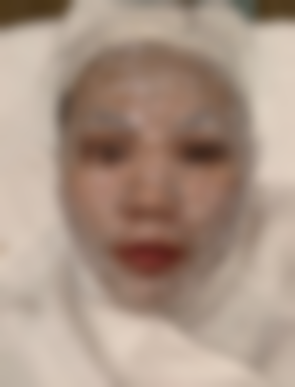 北京加减美点阵激光体验：主任全脸操作2180元，痛感温和到店有礼术后敷膜等掉痂