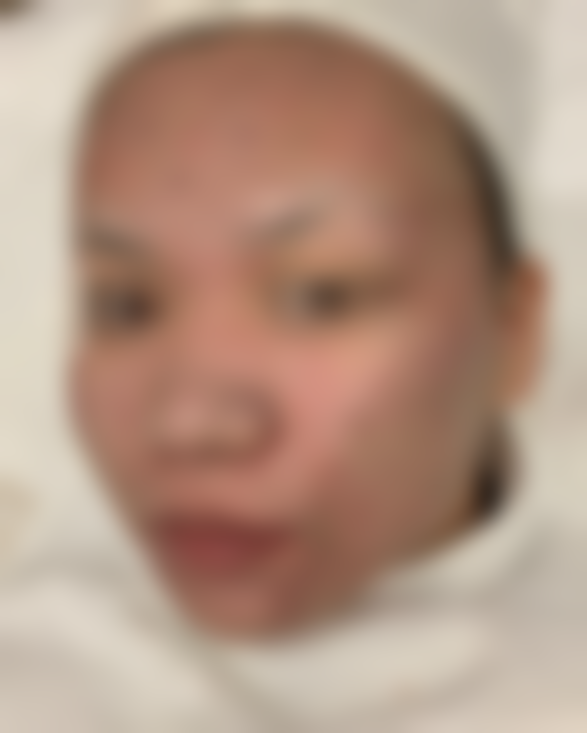 术后贴心护理，坐等掉痂变得更美