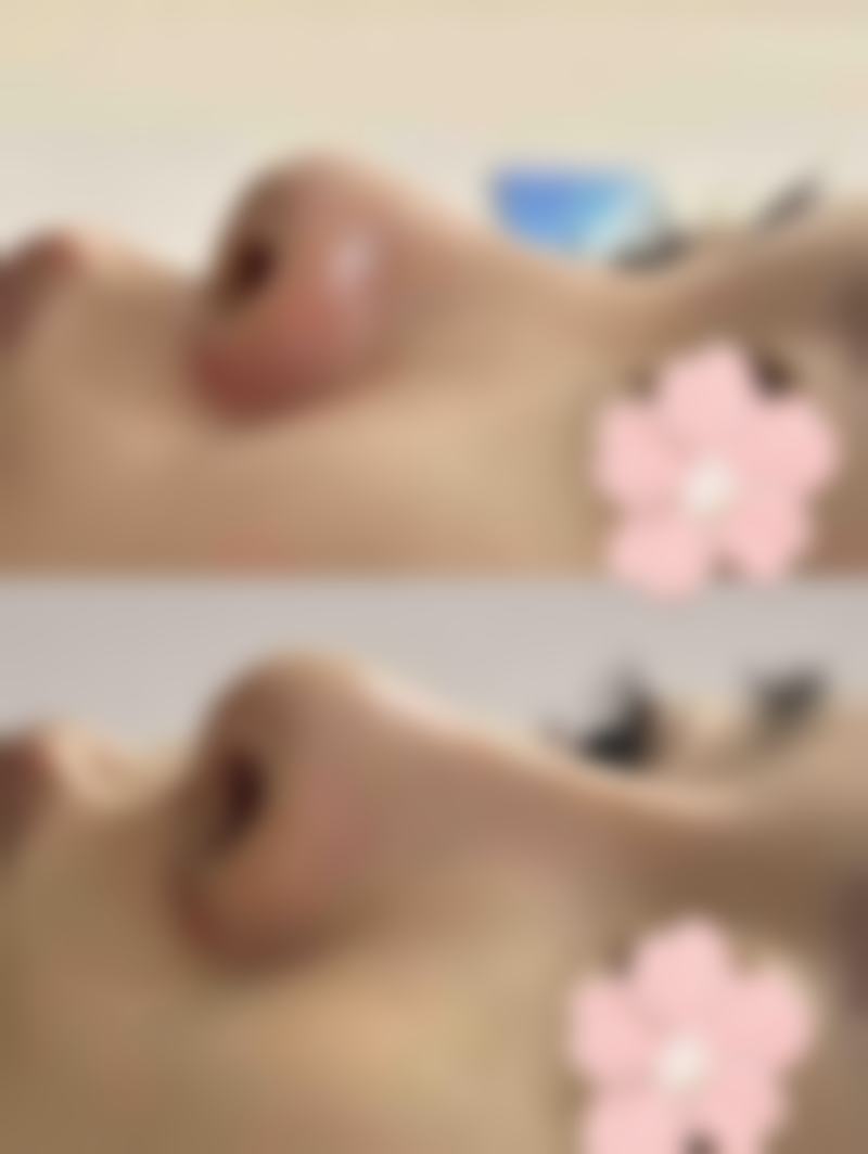 怎样有效祛色素疤痕？多种方法联合更给力