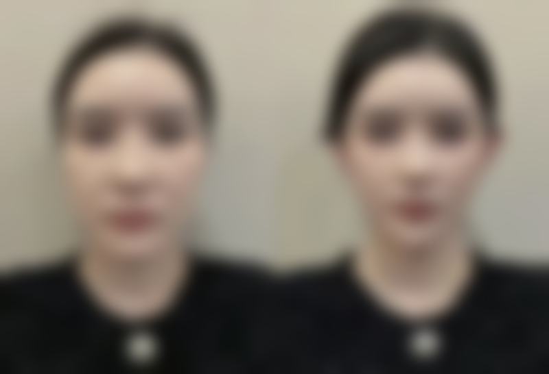 怎样有效祛色素疤痕？药物治疗有成效