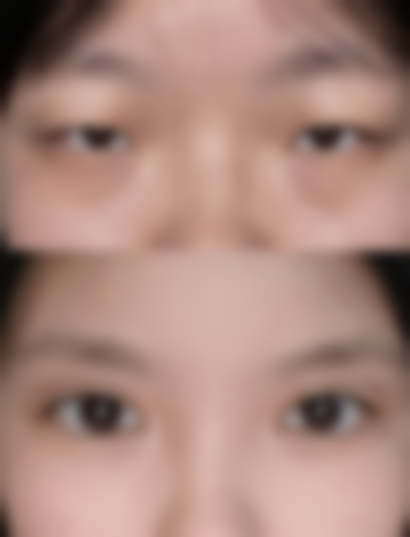 肚子抽脂多久能恢复正常？1 - 3 个月逐步康复，术后多方面护理助你快速回归好状态 