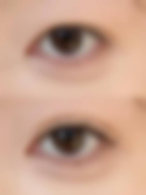 黎咏璇医生双眼皮手术实例