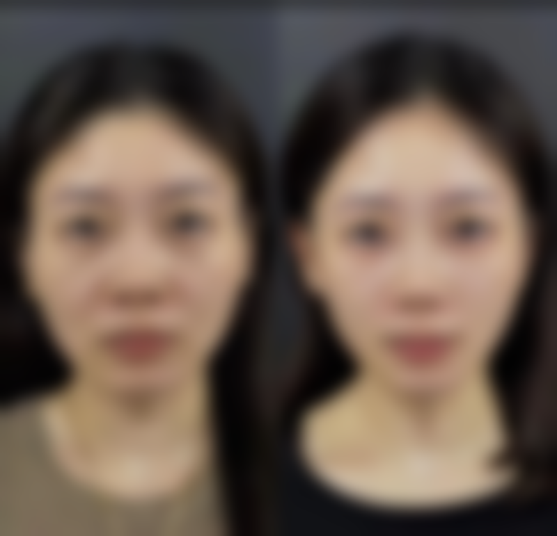 一只单眼皮一只双眼皮是咋回事？年龄增长的影响