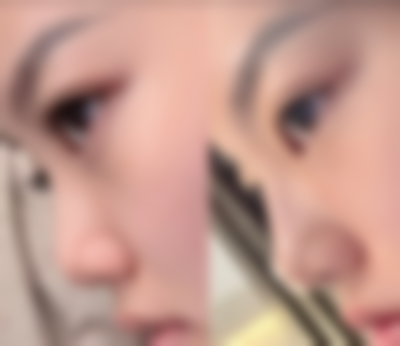 哪里能找到优质的双眼皮修复？选择修复医生的要点