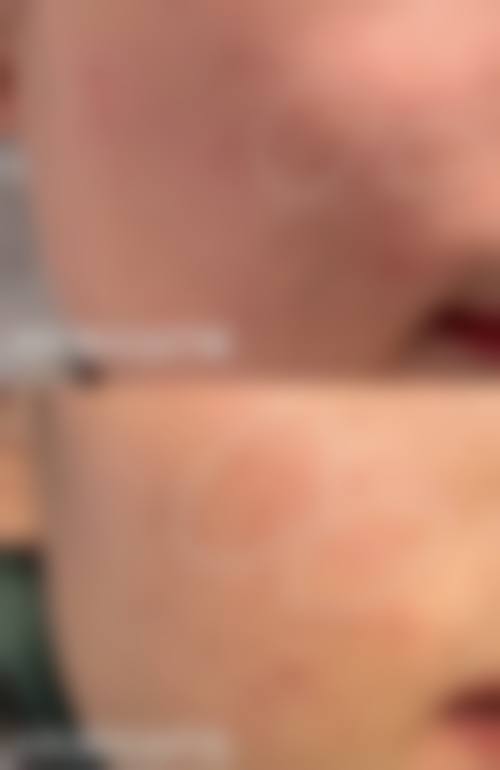 术者操作对双眼皮修复自然的影响